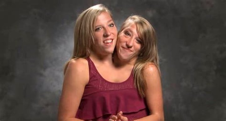 Conjoined Twins Abby and Brittany Hensel Now Work as Teachers |