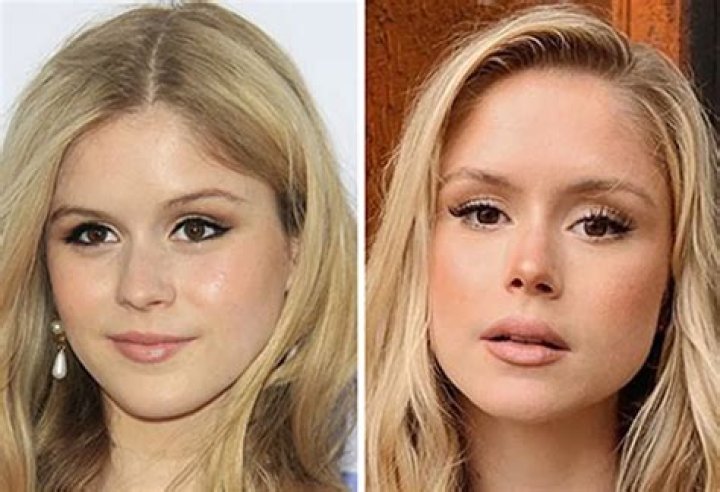 Erin Moriarty's Buccal Fat Journey