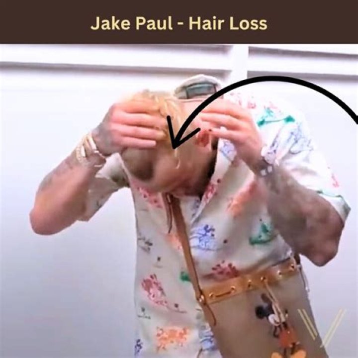 Is Jake Paul Balding? Evidence of His and Logan's Hair Loss |