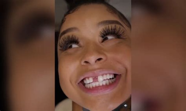 What Happened to Chrisean Rocks Tooth? |